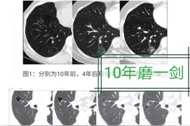 肺磨玻璃结节10年磨一剑，微浸润腺癌阶段是磨玻璃最佳手术时机图片