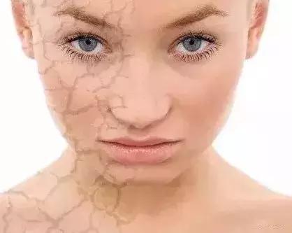 鱼鳞病流汗吗 鱼鳞病流汗吗