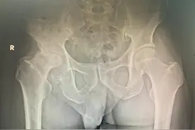 喝酒会导致股骨头坏死？真相在这里图片