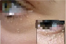 别再用针挑和手抠了，掌握这两步轻松消除脂肪粒，简单还不伤皮肤图片