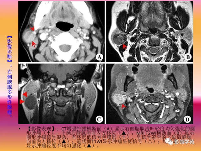 腮腺角化型鳞癌