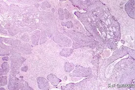 5分钟看懂胃镜病理报告图片