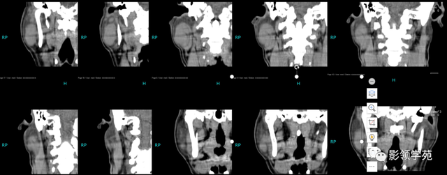 腮腺角化型鳞癌