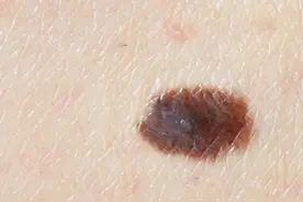 你身上有痣吗？知道这些关于“痣”的常识吗？快来补习一下图片