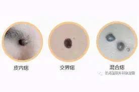 人各有“痣”，有些“问题痣”该切就得切图片