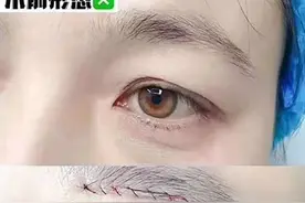 提眉手术后睡觉会“闭不上眼”？给想做的人一些真实建议图片