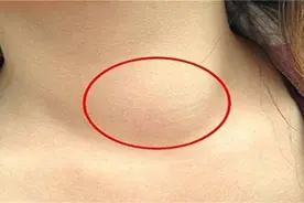 感染艾滋病毒初期有哪些征兆？可以自行检查吗？共用马桶会传染吗图片