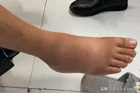 痛风不会无缘无故出现，尿酸高请注意避开痛风发作的十大诱因图片