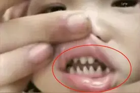 孩子长了一口“鲨鱼牙”，妈妈着急送医，医生怒斥：无知害了孩子图片