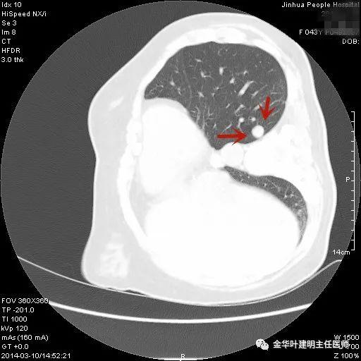 叶建明谈结节：检查发现肺实性结节怎么办？个人版实用指南