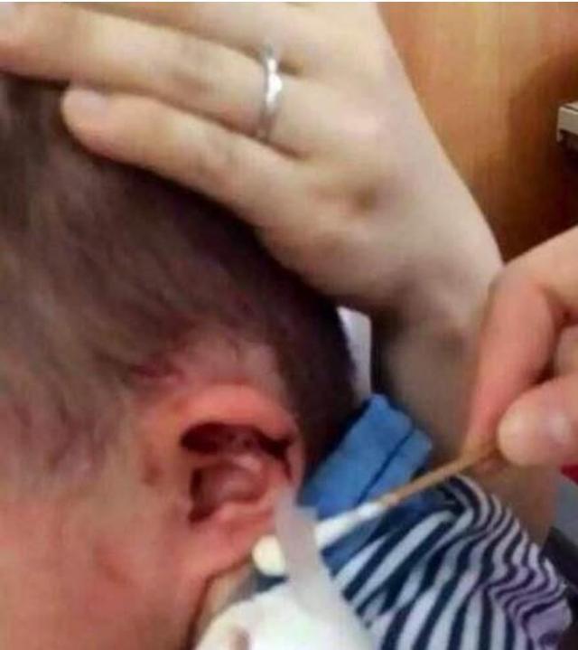 孩子身上起白色鸡皮疙瘩