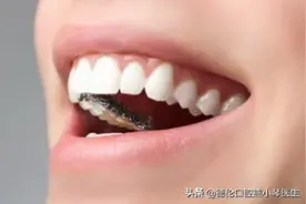 舌侧隐形矫正的优缺点图片