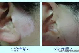 逃不出的白斑噩梦——母女两想通过纹身遮住身上白斑，却越遮越大图片