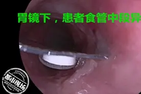 她将药品带包装一起吞下！像刀片一样，划伤食道图片