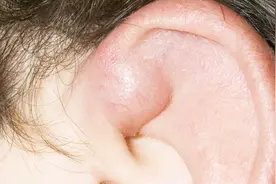 耳廓囊肿会自己消除吗？需要哪些干预手段？视频封面
