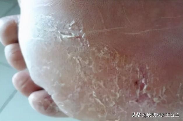 脚底表皮角化过度