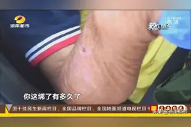 被眼镜蛇咬伤后，男子神情恍惚…情况紧急图片
