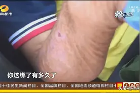 被眼镜蛇咬伤后，男子神情恍惚…情况紧急图片