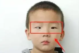 5岁孩子长期玩“玩具”，黑眼珠逐渐“消失”，医生：很难恢复了图片