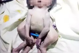 环球奇闻！缅甸内比都一名孕妇诞下罕见“双头”男婴图片