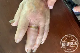 赣州：佩戴戒指21年，已经牢牢嵌入肉里，老人想取下大费周折图片