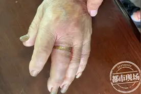 赣州：佩戴戒指21年，已经牢牢嵌入肉里，老人想取下大费周折图片