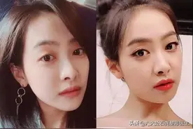 “双眼皮修复手术”比第一次手术难度大，该不该选择修复？图片