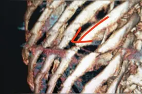 骨折或者伤到骨头了，都是去骨科瞧吗？图片