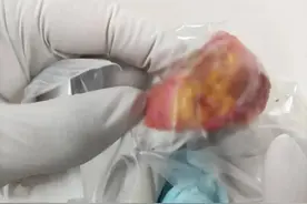 杭州34岁女子左腿长了肿块，病理结果让人大跌眼镜，里面竟住着它们图片