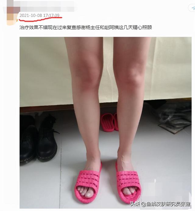 鱼鳞皮肤的防治