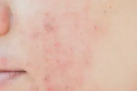 用盐搓一搓就能祛除黑头粉刺，专家：不要乱用偏方，根本没用图片