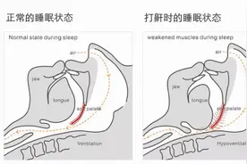 打呼噜是睡得香？小心睡眠呼吸暂停综合症图片