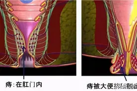 肛门边的肉球，除了痔疮，还可能是什么，需要治疗吗？图片