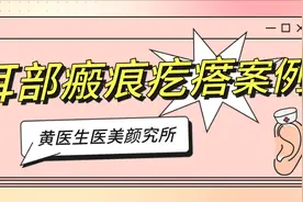 耳部瘢痕疙瘩案例图片