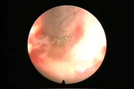 椎管内用电钻还能精准打磨？哈医大一院省内首次应用脊柱内镜下磨钻动力系统治疗腰椎退变性疾病图片