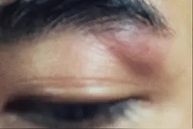 32岁男星拍武打戏左眼受伤，眼部红肿险毁容？曾被内涵靠脸走红图片