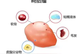 婴儿屁股上竟长了“小尾巴”！怎么回事？图片