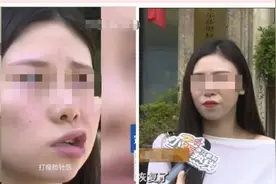 29岁姑娘打瘦脸针后突然面瘫图片