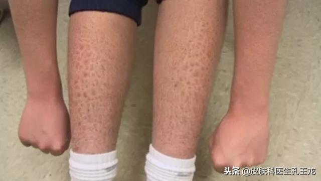 腿上有鱼鳞一样怎么回事 腿上有鱼鳞一样怎么回事