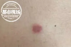 怪异！男子扫墓归来 肚子上出现奇异黑斑图片