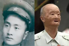 全身被战火烧伤后，20岁的他做出了这个决定......图片