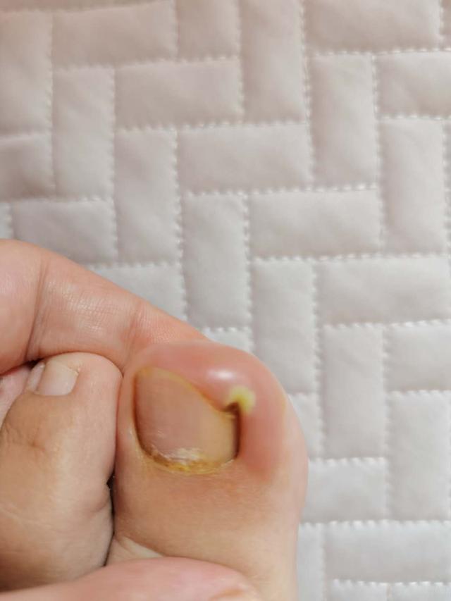 怀孕了有甲沟炎怎么办