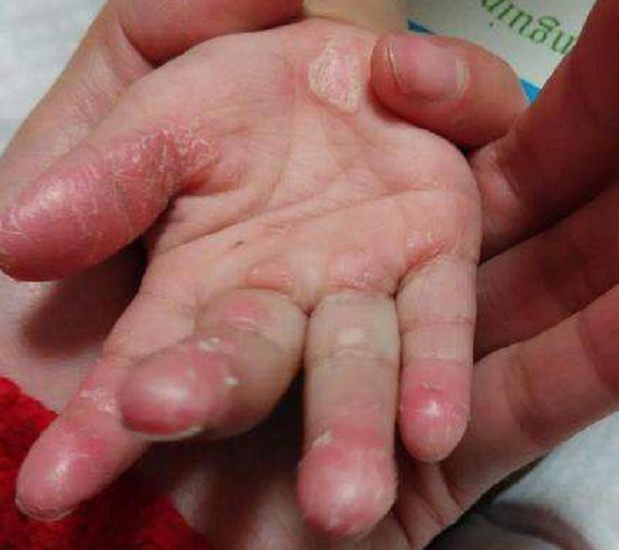 指端角化性类弹性纤维病