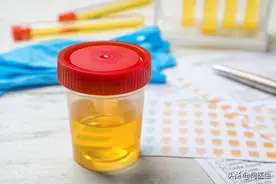 男性出现泡沫尿怎么回事？医生告诉你，这些疾病会导致尿中有泡沫图片