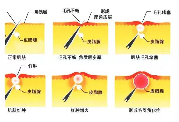 毛周角化症华肤优惠 毛周角化症华肤优惠
