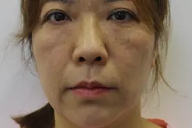 52岁小拉皮术后5周，脸型的改变“最大”图片