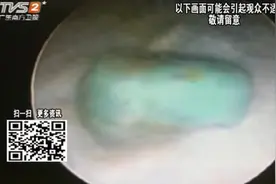 男孩游泳后左耳突然听不见，到医院检查，竟然从耳朵夹出一块橡皮视频封面