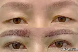 提眉手术多久恢复自然？提眉手术可以维持多久？提眉手术疼吗？图片