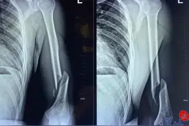 啪！28岁健身达人掰手腕，把手臂掰成粉碎性骨折图片