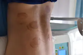 消防战士腰间盘突出引起腿部麻痛，中医：日常锻炼、饮食需养护图片